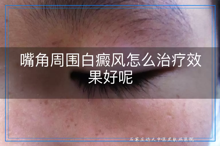 嘴角周围白癜风怎么治疗效果好呢