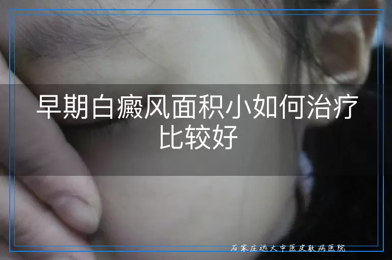 早期白癜风面积小如何治疗比较好