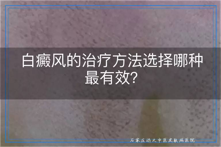 白癜风的治疗方法选择哪种最有效？