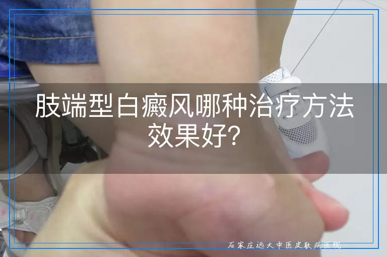 肢端型白癜风哪种治疗方法效果好？