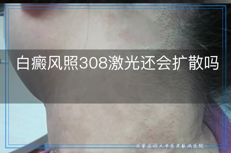 白癜风照308激光还会扩散吗