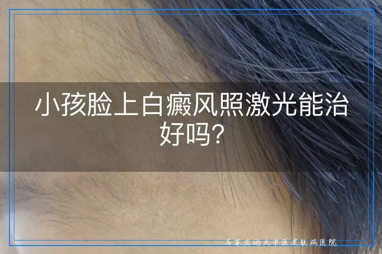 小孩脸上白癜风照激光能治好吗？