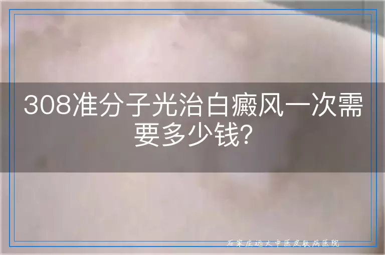 308准分子光治白癜风一次需要多少钱？