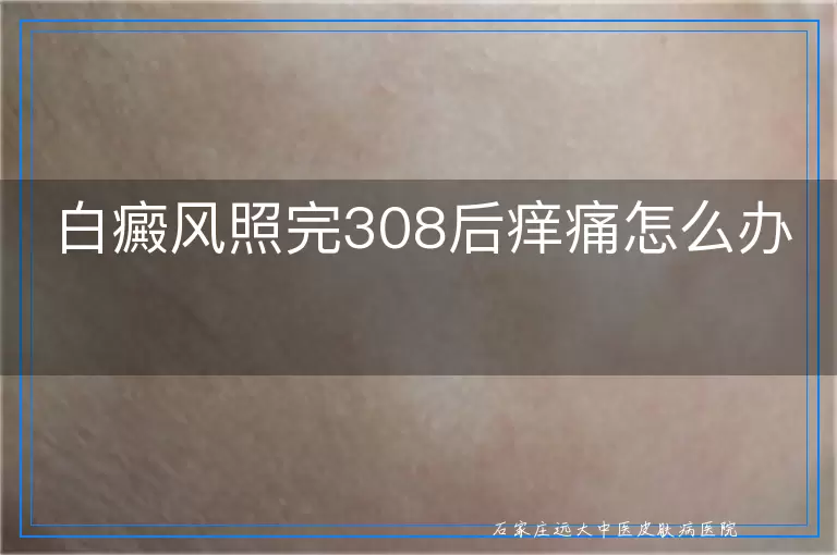 白癜风照完308后痒痛怎么办