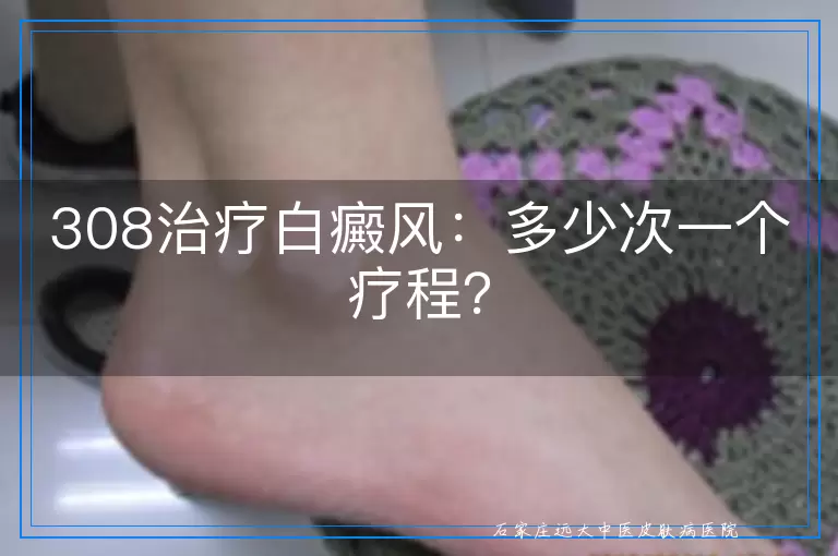 308治疗白癜风：多少次一个疗程？