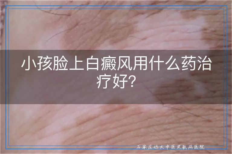 小孩脸上白癜风用什么药治疗好？
