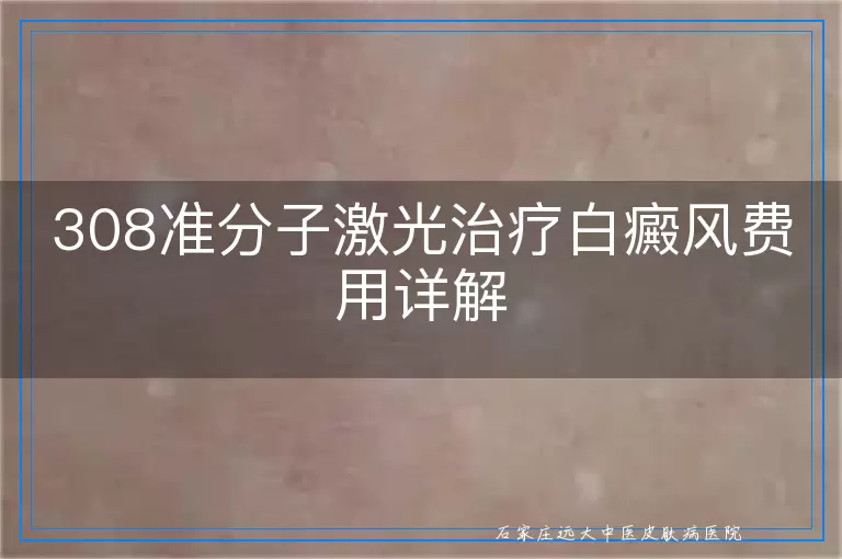 308准分子激光治疗白癜风费用详解