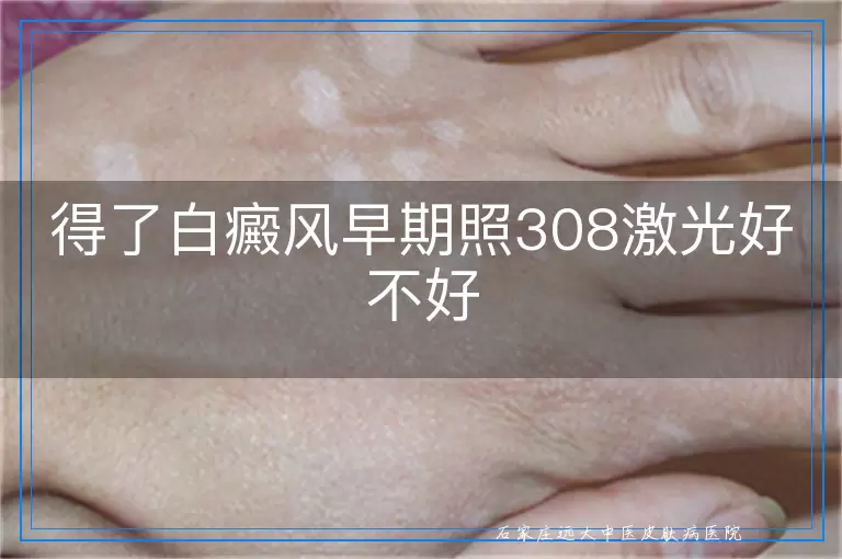 得了白癜风早期照308激光好不好