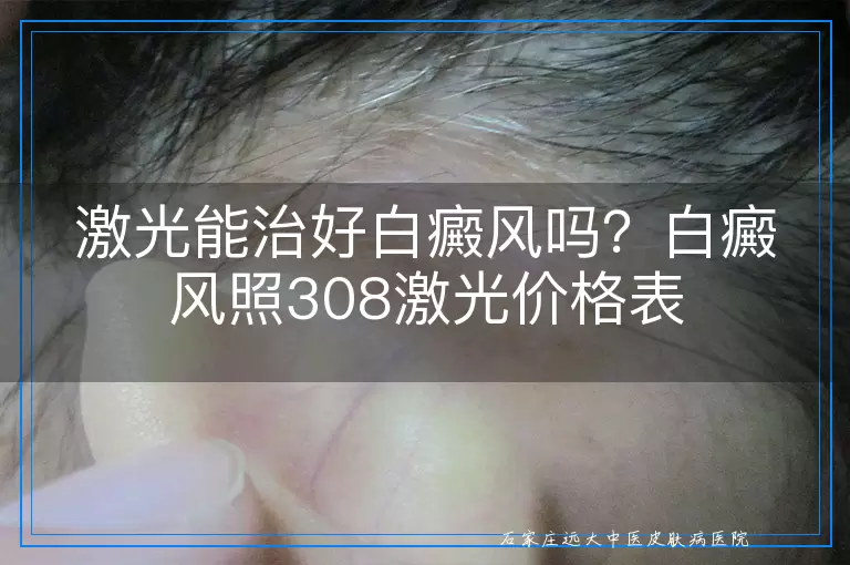 激光能治好白癜风吗？白癜风照308激光价格表