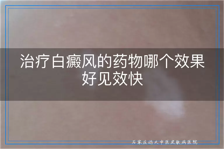 治疗白癜风的药物哪个效果好见效快