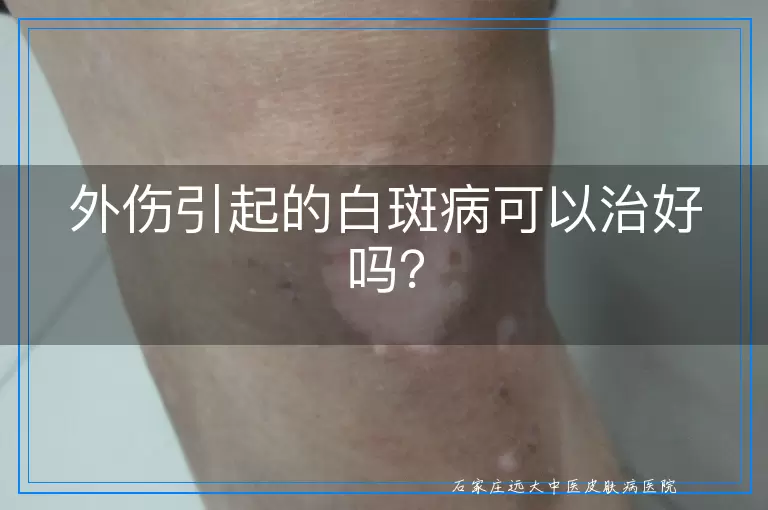外伤引起的白斑病可以治好吗？