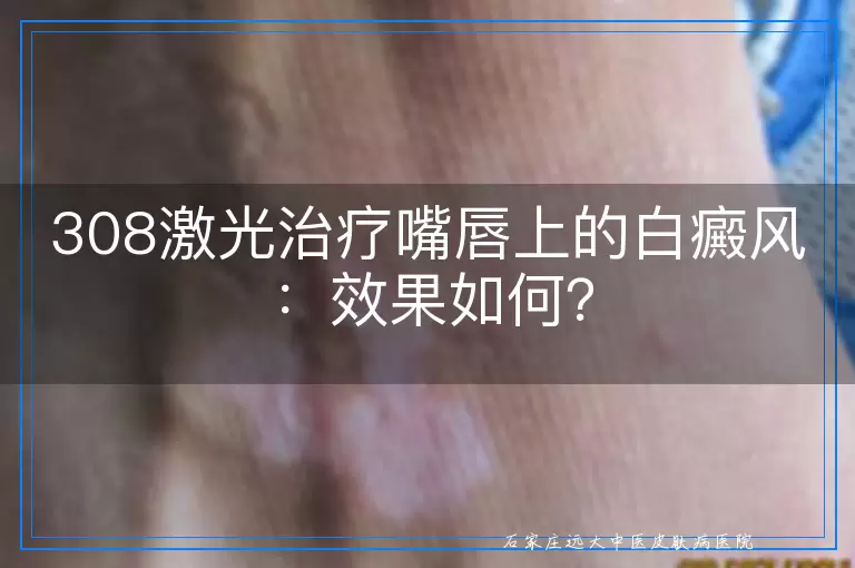 308激光治疗嘴唇上的白癜风：效果如何？