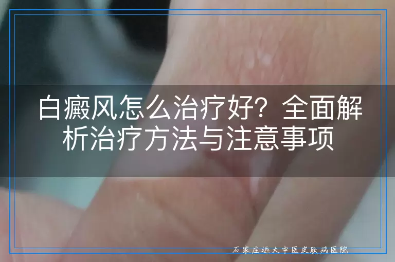 白癜风怎么治疗好？全面解析治疗方法与注意事项