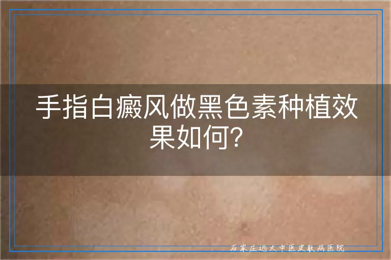 手指白癜风做黑色素种植效果如何？