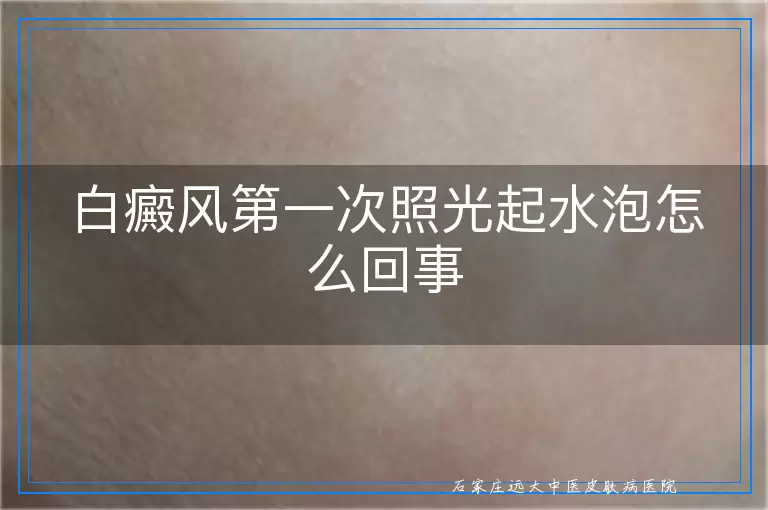 白癜风第一次照光起水泡怎么回事