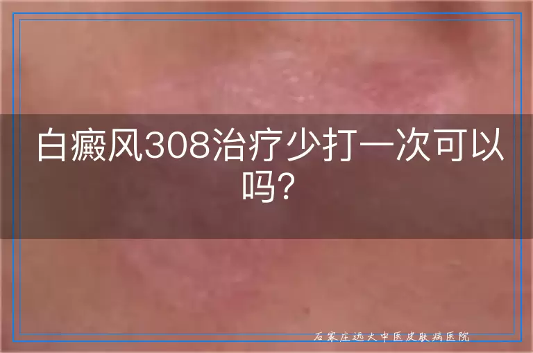 白癜风308治疗少打一次可以吗？