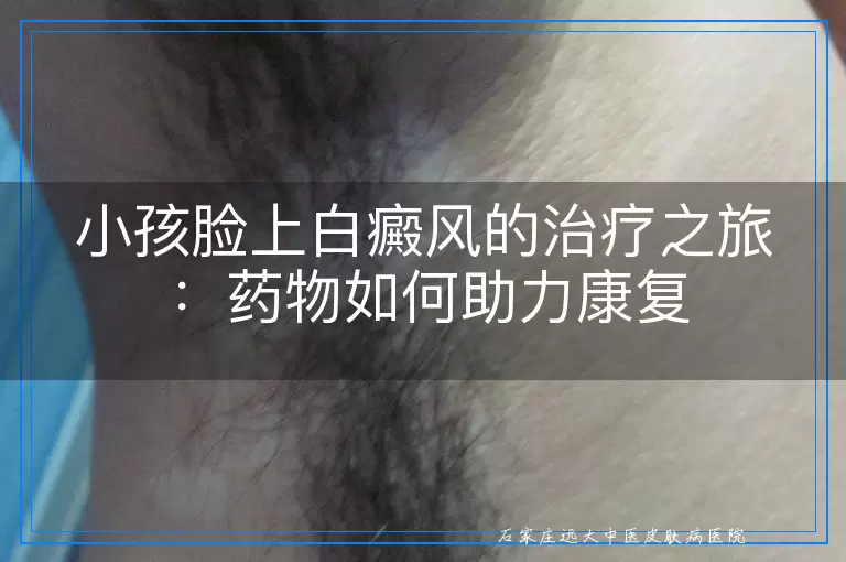 小孩脸上白癜风的治疗之旅：药物如何助力康复