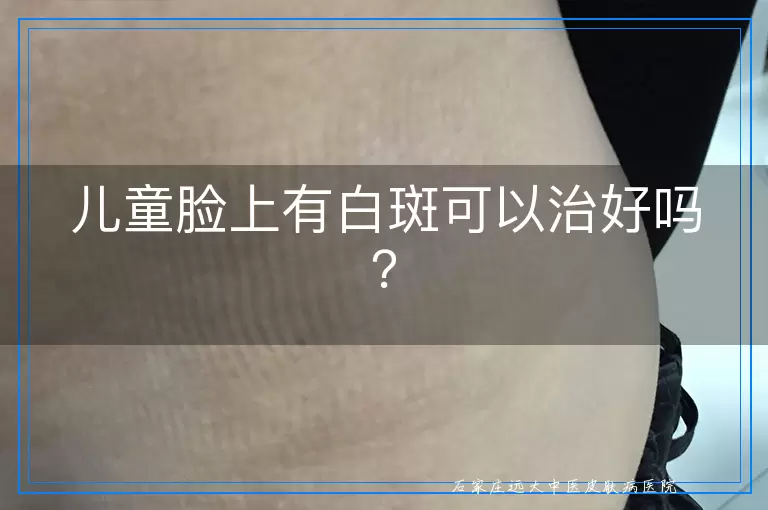 儿童脸上有白斑可以治好吗？