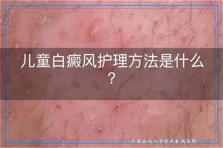 儿童白癜风护理方法是什么？