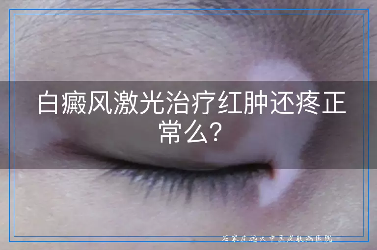 白癜风激光治疗红肿还疼正常么？