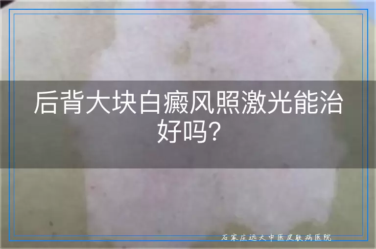 后背大块白癜风照激光能治好吗？