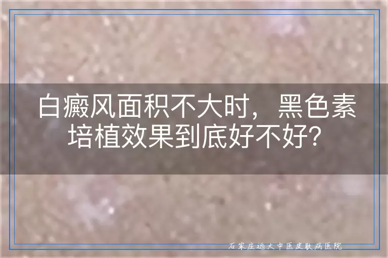 白癜风面积不大时，黑色素培植效果到底好不好？