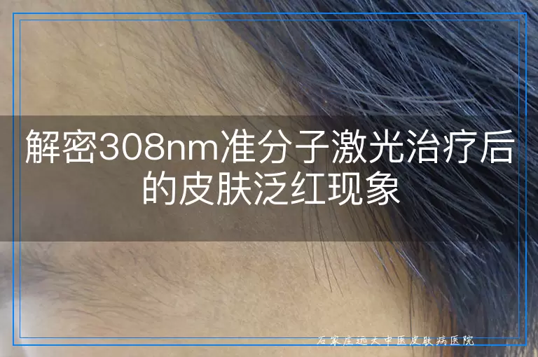 解密308nm准分子激光治疗后的皮肤泛红现象