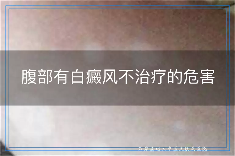 腹部有白癜风不治疗的危害