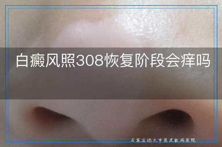 白癜风照308恢复阶段会痒吗