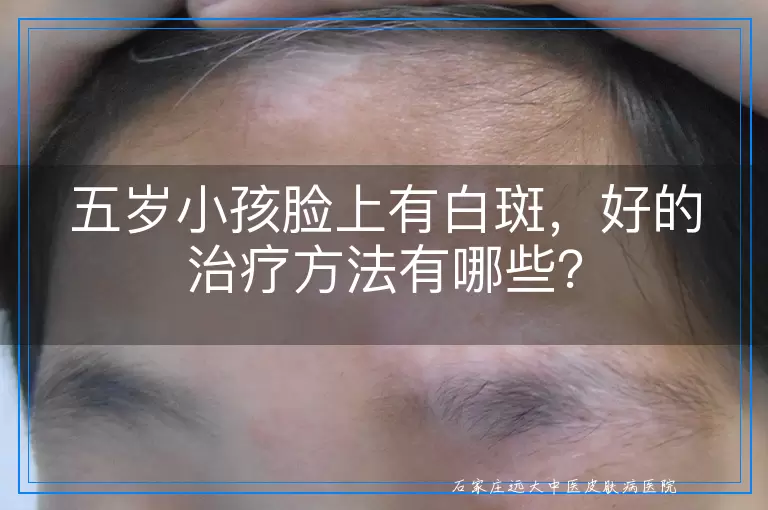 五岁小孩脸上有白斑，好的治疗方法有哪些？