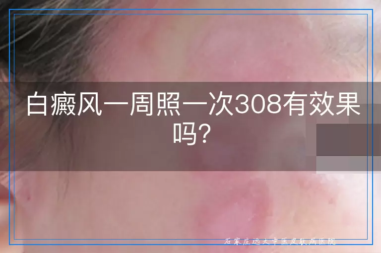 白癜风一周照一次308有效果吗？