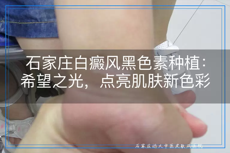 石家庄白癜风黑色素种植：希望之光，点亮肌肤新色彩