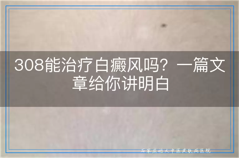 308能治疗白癜风吗？一篇文章给你讲明白