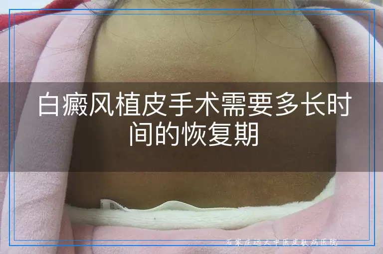 白癜风植皮手术需要多长时间的恢复期