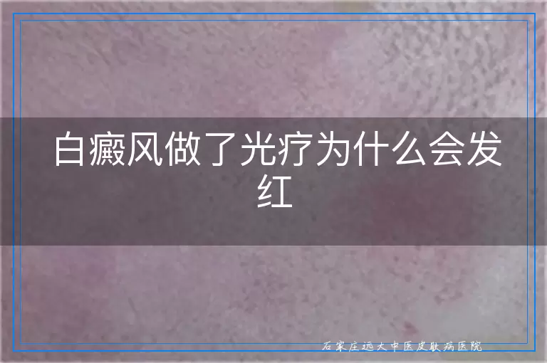 白癜风做了光疗为什么会发红
