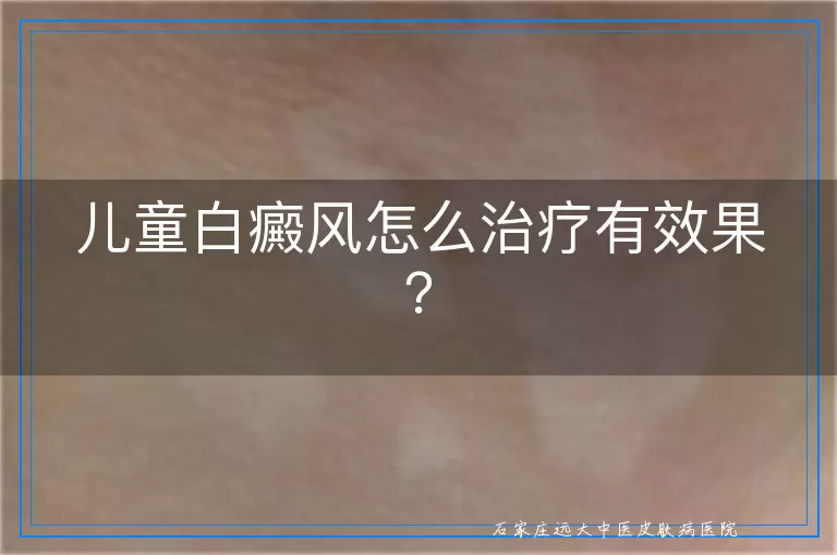 儿童白癜风怎么治疗有效果？