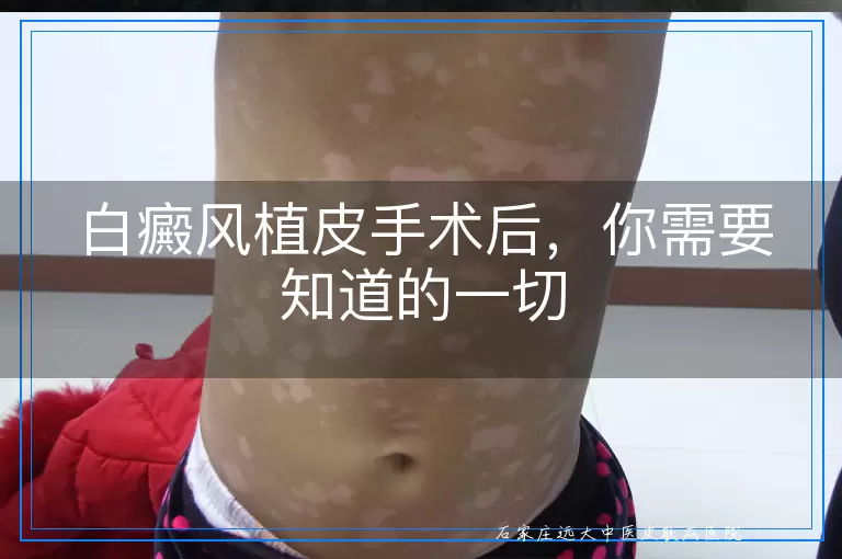 白癜风植皮手术后，你需要知道的一切