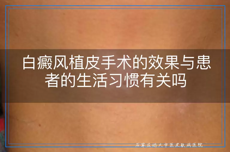 白癜风植皮手术的效果与患者的生活习惯有关吗