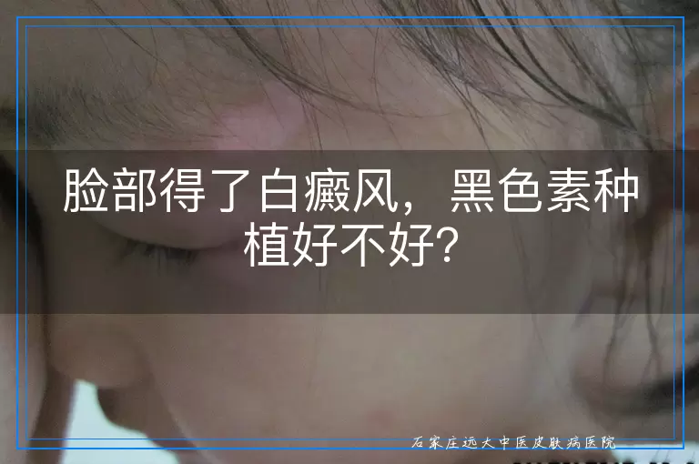 脸部得了白癜风，黑色素种植好不好？