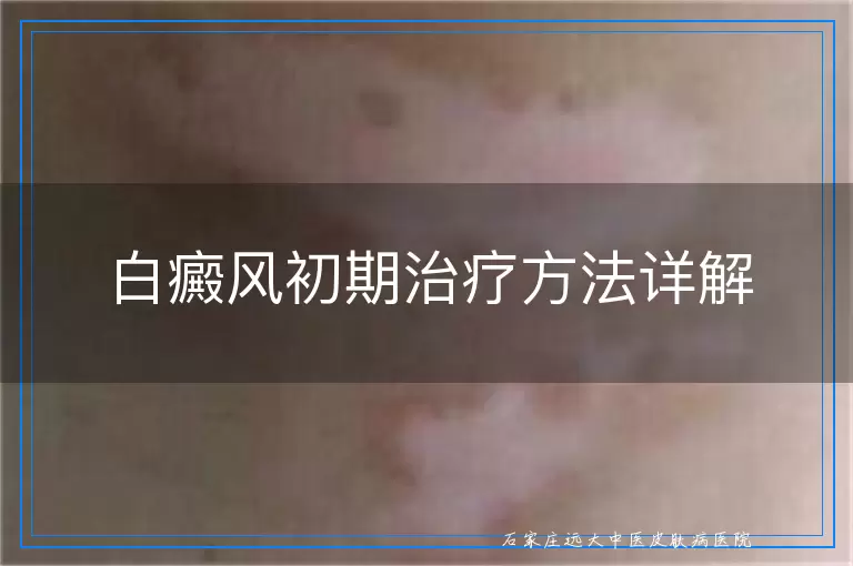 白癜风初期治疗方法详解