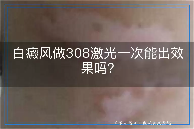 白癜风做308激光一次能出效果吗？
