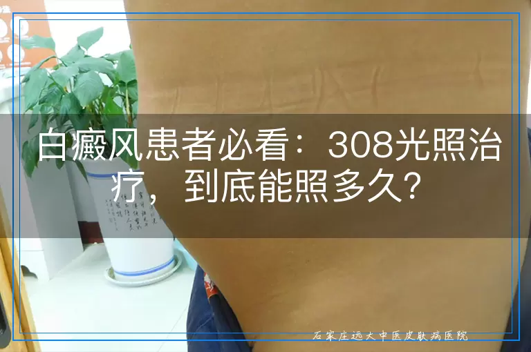 白癜风患者必看：308光照治疗，到底能照多久？