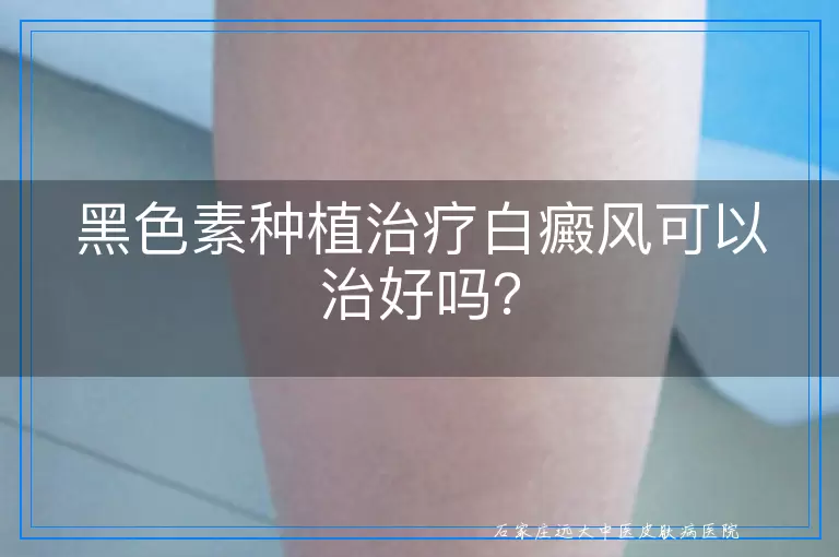 黑色素种植治疗白癜风可以治好吗？