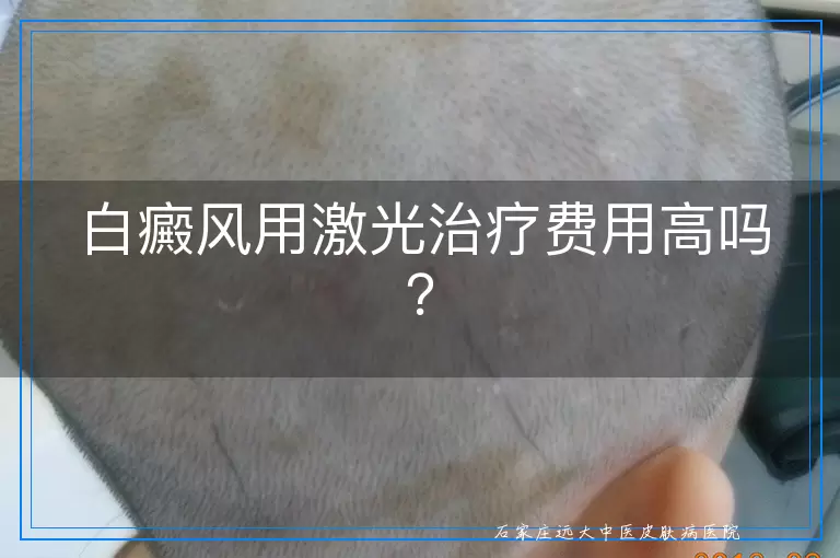 白癜风用激光治疗费用高吗？