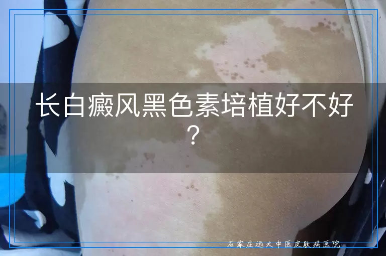 长白癜风黑色素培植好不好？