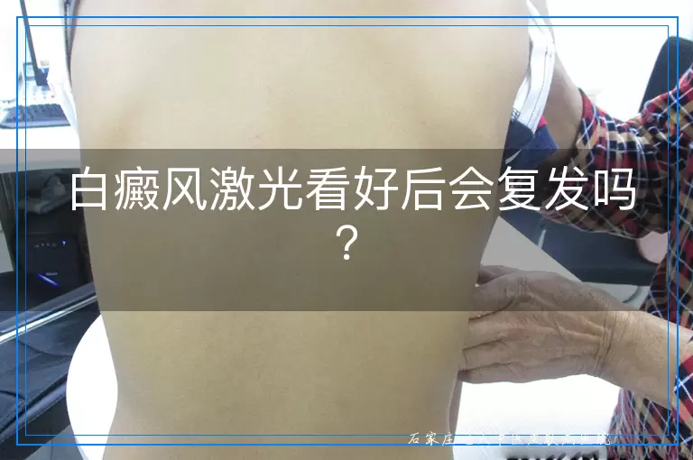 白癜风激光看好后会复发吗？