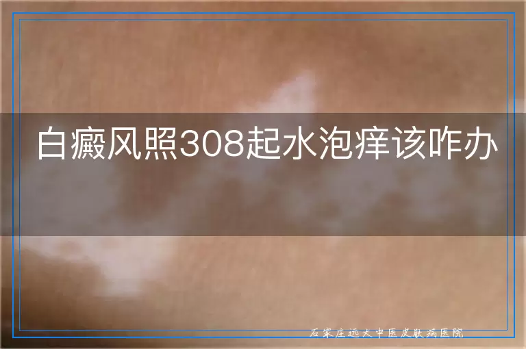 白癜风照308起水泡痒该咋办
