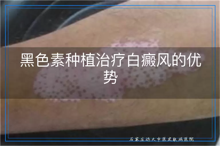 黑色素种植治疗白癜风的优势