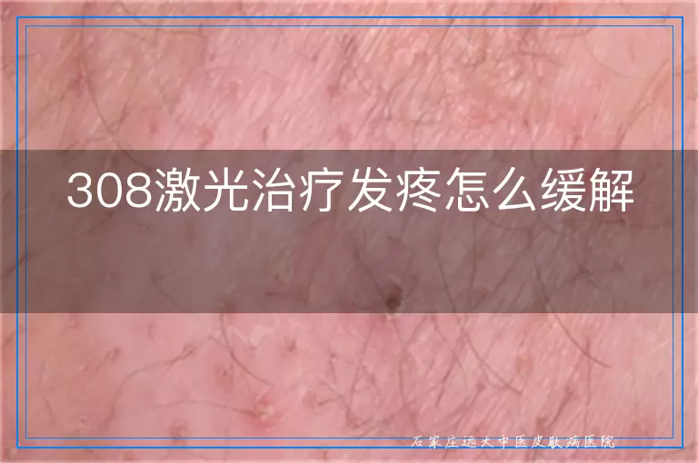 308激光治疗发疼怎么缓解