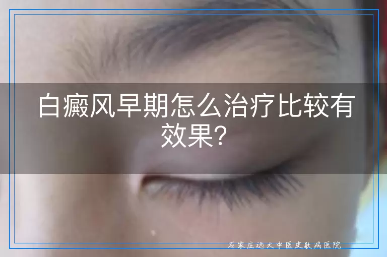 白癜风早期怎么治疗比较有效果？